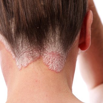 La psoriasis provoca la formación de placas de piel gruesas y descamaciones